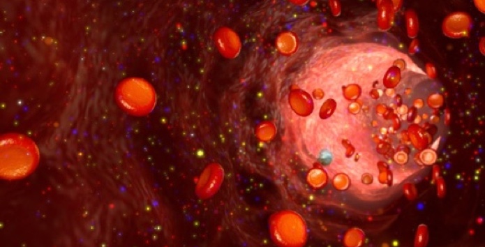 Aneurysma-Bonn-operieren-Klinik