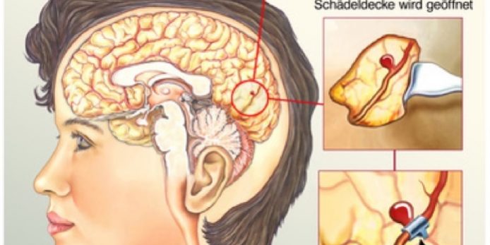 Aneurysma-Siegen-Operation-behandeln