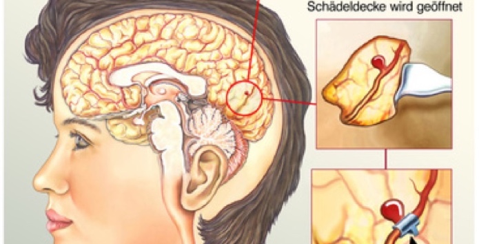 Aneurysma-Siegen-Operation-behandeln