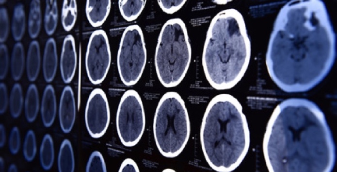 Hirntumor-Bonn-OP-operieren-Klinik