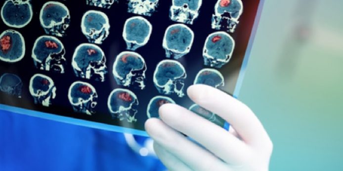 OP-Bonn-Klinik-Hirntumor