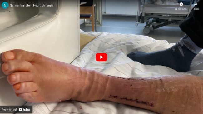 neurochirurige-sehnentransfer