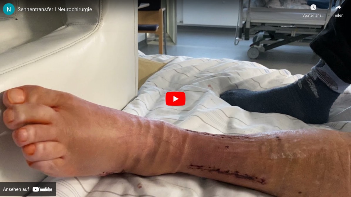 neurochirurige-sehnentransfer
