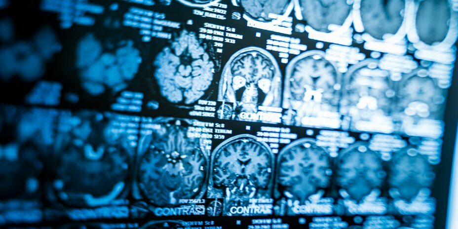 Aneurysma: Therapie für Patienten aus Dortmund