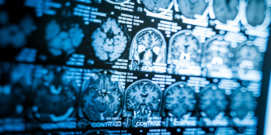 aneurysma-therapie-patienten-dortmund Aneurysma: Therapie für Patienten aus Dortmund