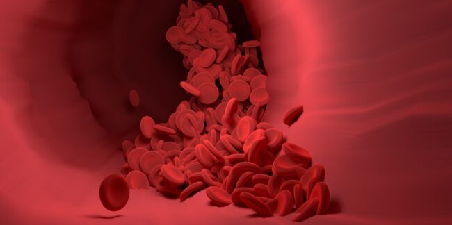 Angiom Behandlung in Köln