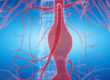 Aneurysma vorsorglich operieren?