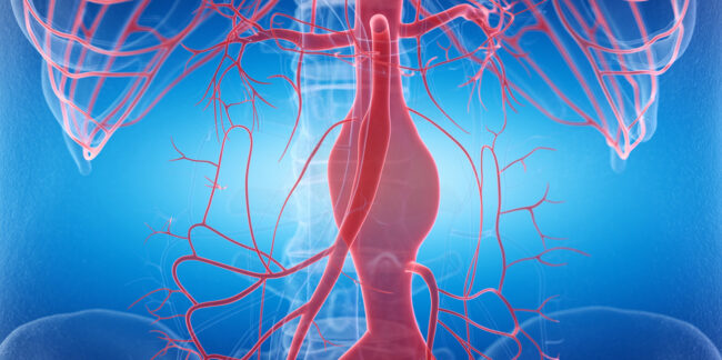 Aneurysma vorsorglich operieren?