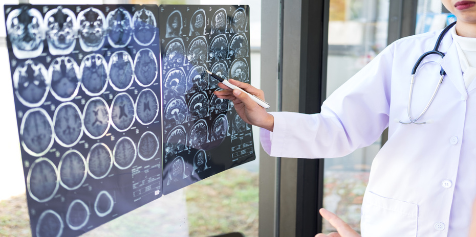 Angiom: Behandlung in neurovaskulärem Zentrum Angiom: Behandlung in neurovaskulärem Zentrum