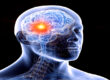 Intraoperatives Monitoring bei Hirntumor OP