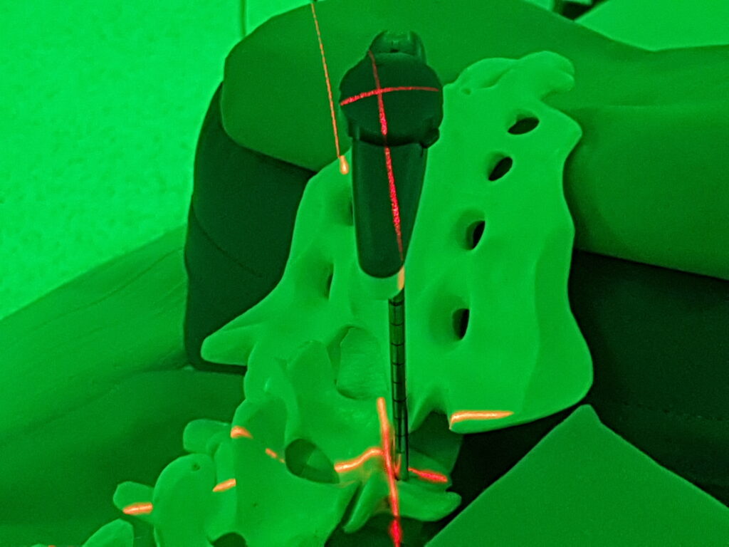 Versteifung Lendenwirbelsäule
