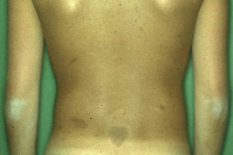 Neurofibromatose