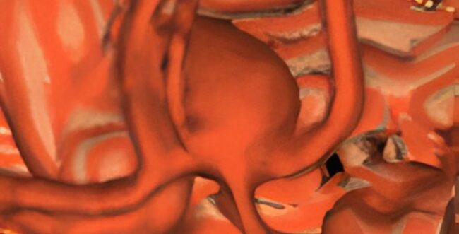 3D Rekonstruktion eines großen Aneurysmas zum Thema - Was ist ein Aneurysma