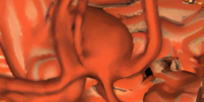 3D Rekonstruktion eines großen Aneurysmas zum Thema - Was ist ein Aneurysma